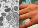 OMS diz que não há urgência para imunizante contra varíola dos macacos